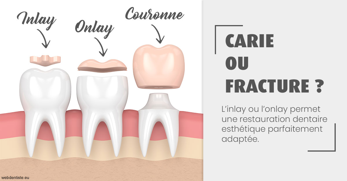 https://docteur-caroline-barnoin.chirurgiens-dentistes.fr/T2 2023 - Carie ou fracture 1