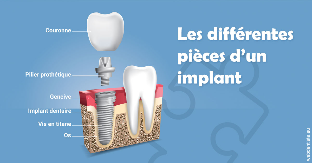 https://docteur-caroline-barnoin.chirurgiens-dentistes.fr/Les différentes pièces d’un implant 1